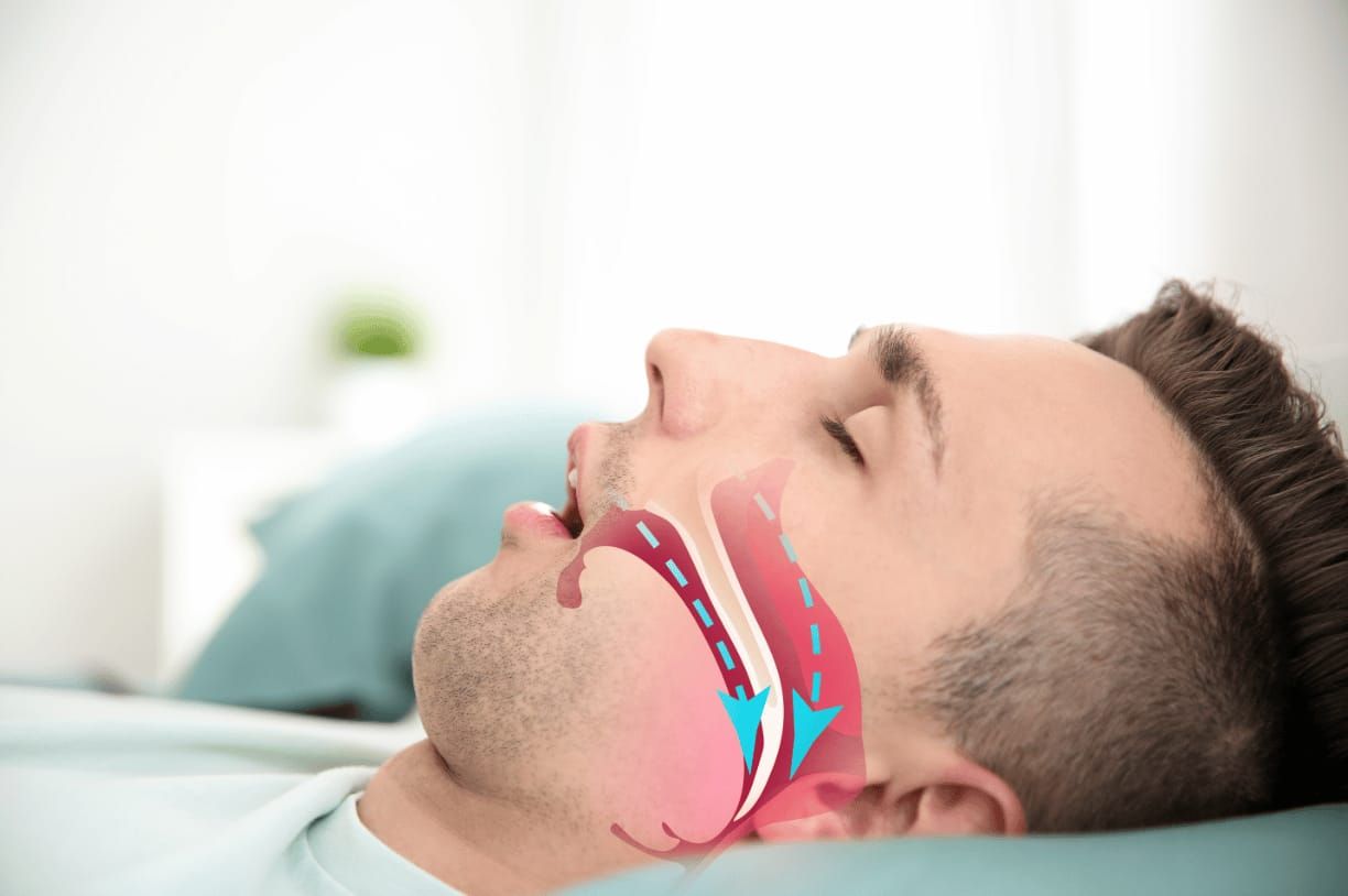 CPAP oder Unterkieferprotrusionsschiene (UKPS)?